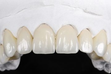 Dental Crowns