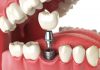 Dental Tooth Implants