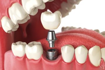 Dental Tooth Implants