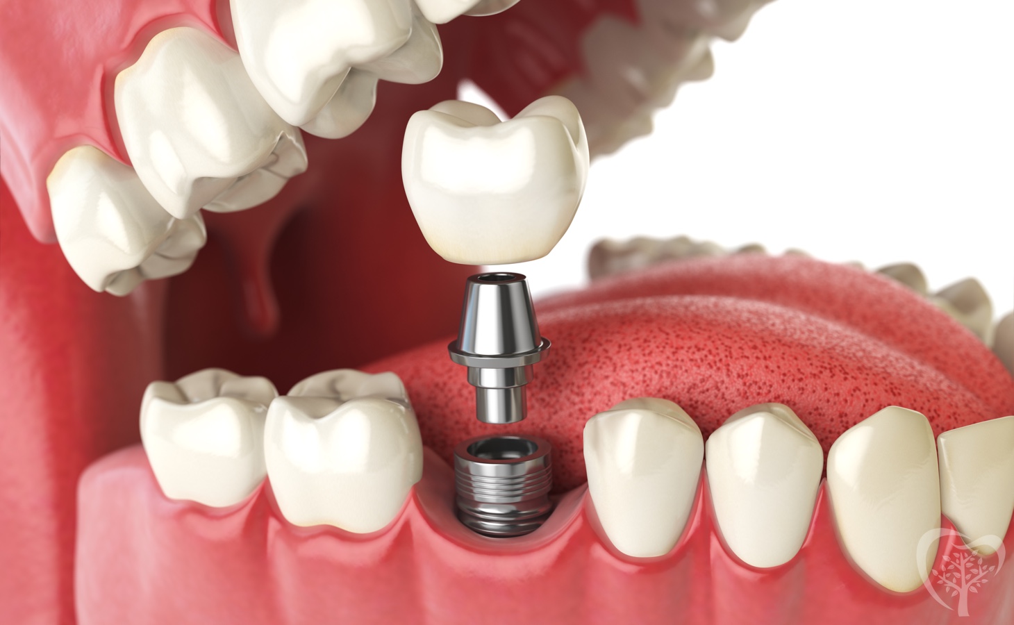 Dental Tooth Implants