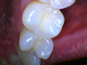 Intraoral Camera - Healthy Teeth